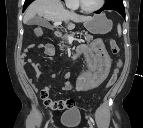 Contrast-enhanced CT scans of the abdomen. The images demonstrate diffuse, circumferential wall thickening of multiple small bowel loops accompanied by adjacent mesenteric edema and inflammatory stranding. Decompressed distal small bowel segments are also noted, features which, in this clinical context, were attributed to severe enteric vasculitis rather than mechanical obstruction
