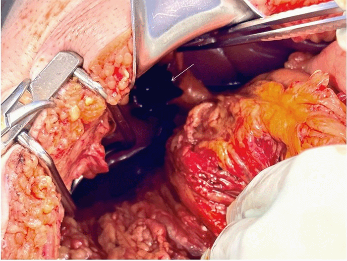 Intraoperative photograph demonstrating isolated rupture of the gallbladder. The arrow indicates the perforation of the gallbladder fundus