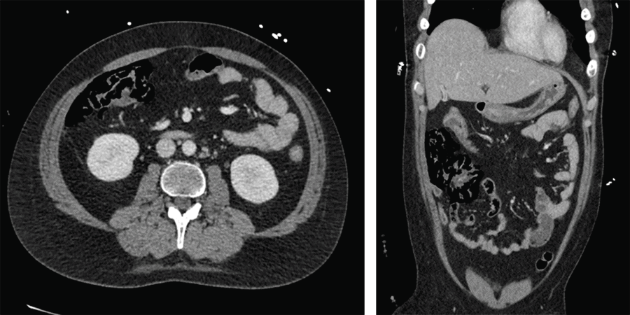 There is extensive new pneumatosis within the wall of ascending colon with evidence of extraluminal gas contained within adjacent mesentery. Remainder of colon is thick-walled but decompressed