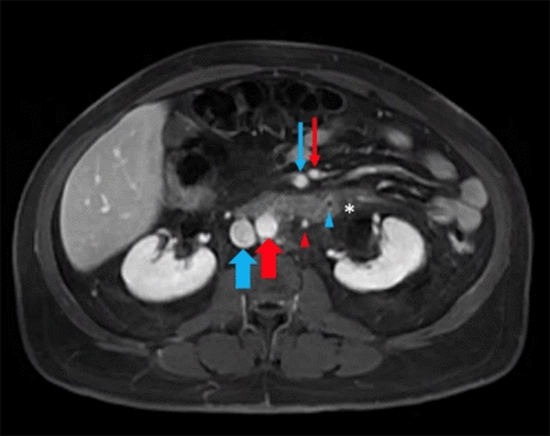 . B) Magnetic resonance imaging venous phase depicting inferior mesenteric vein with filling defect (blue arrowhead) and surrounding inflammation (white asterisk). Inferior mesenteric artery (red arrowhead), superior mesenteric artery (thin red arrow), superior mesenteric vein (thin blue arrow), aorta (thick red arrow), and inferior vena cava (thick blue arrow) labeled for reference.