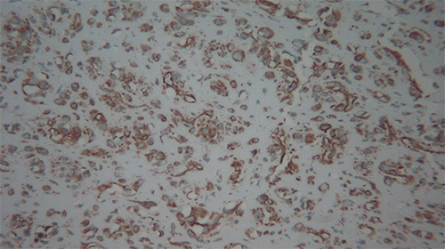 Intermediate magnification (10x) showing sheets of spindle cells positive for SMA
