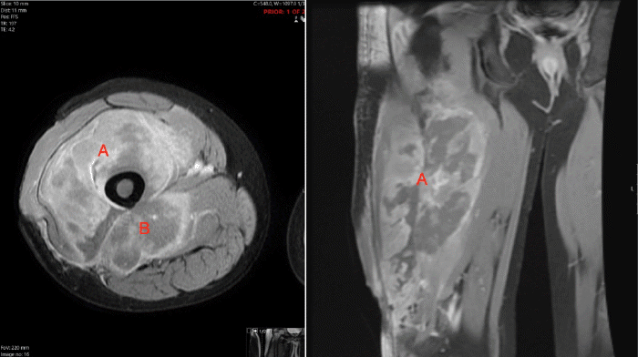 Axial and coronal T2-weighted magnetic resonance imaging of the right thigh revealing a large, infiltrative mass originating from the right femoral shaft and extending into the (A) anterior and (B) posterior thigh compartments