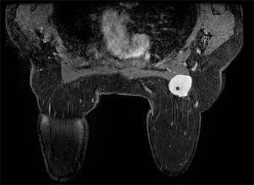 Image depicts right breast mass with intimal connection with pectoralis muscle, 3 x 3.5 x 4.5 cm, very dense lobulated mass with postbiopsy clip marker