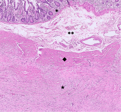 A) Predominantly subserosal involvement characterized by an indistinct spindle cell proliferation, with localized extension into the muscularis propria (*mucosa; **submucosa; ◆muscularis propria; ★tumor)