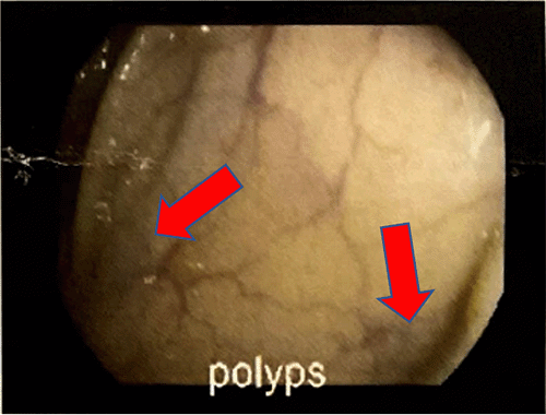 Sessile polyps of varying size in the descending colon, subsequently removed by polypectomy