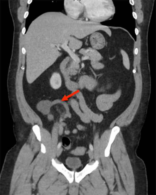 The appendix appears dilated and inflamed (findings consistent with appendicitis)