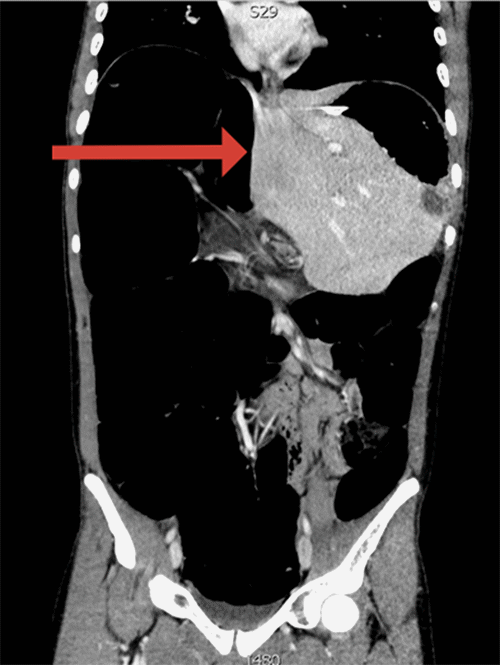 Dilated colon with medial displacement of the liver