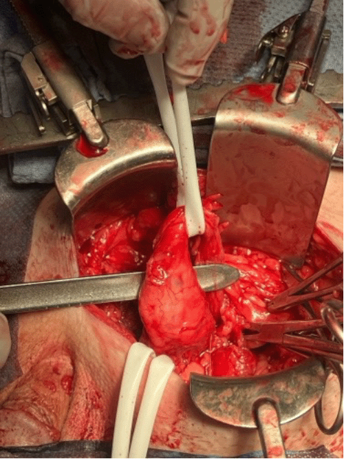 Isolation of the markedly dilated (hydronephrotic) and redundant herniated left ureter with a Penrose drain prior to reduction