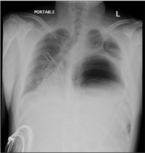 Chest radiograph following nasogastric tube placement demonstrating persistent rightward mediastinal shift secondary to a large gastrothorax