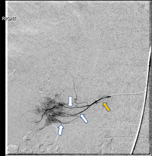 The right hepatic artery (yellow arrow) supplies the tumor (not shown) via three second-order branches (white arrows). Opacification of these branches confirms their contribution to tumor blood flow.