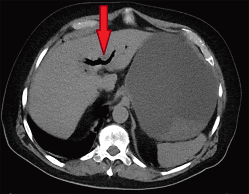 Non-contrast axial CT of the upper abdomen at the level of the liver. This image reveals branching, low-attenuation areas within the intrahepatic biliary tree (arrow), consistent with pneumobilia, secondary to a cholecystoenteric fistula