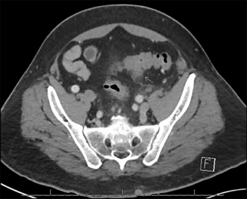 A) CT of resected sigmoid colon segment with diverticulitis (white arrow) and scattered diverticulum