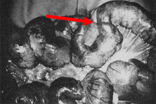 Scan appreciated as high-grade small bowel obstruction with transition point in distal jejunum/proximal ileum in left lower quadrant, at the site of the surgical anastomosis, marked by arrow.