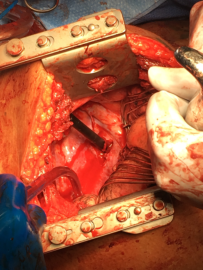 Figure 3. Intraoperative gross image