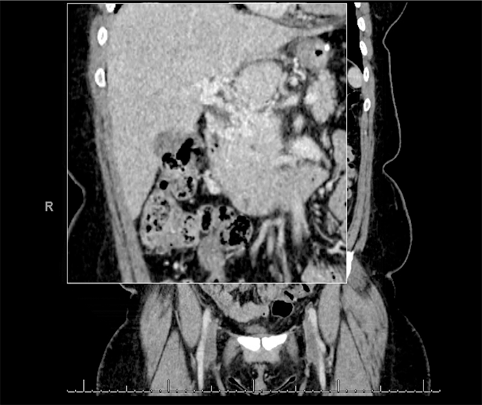 Extensive Portomesenteric Venous Thrombosis after Laparoscopic Sleeve