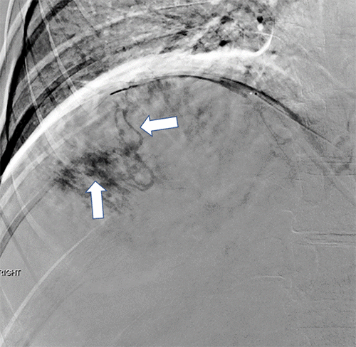 Selective angiography of a branch of the right inferior phrenic artery shows opacification, followed by subsequent filling of the hemangioma, confirming arterial supply