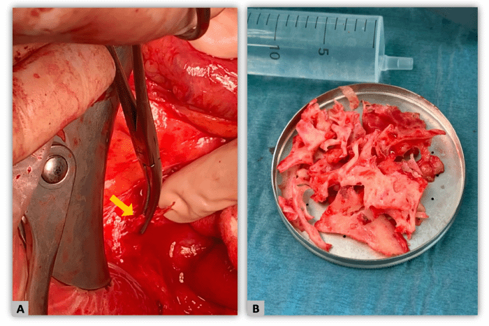 A) Intraoperative identification of bone fragment with an angulated edge within the intestinal mesentery (yellow arrow). B) Surgical removal of multiple bone fragments in varying sizes