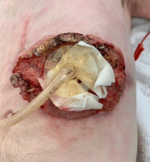 A) Cutaneous squamous cell carcinoma surrounding gastrostomy tube