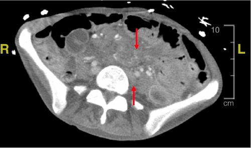 (C) Axial view of the pelvis demonstrating mesenteric and retroperitoneal lymphadenopathy