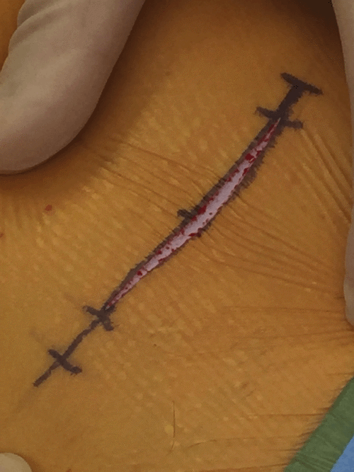 A) Traction technique for further separating epidermal layer to protect it from thermal injury