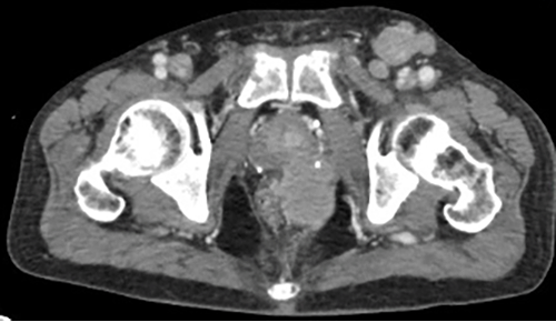 Left external iliac lymphadenopathy. Cranial extent of tumor with mass effect on rectum