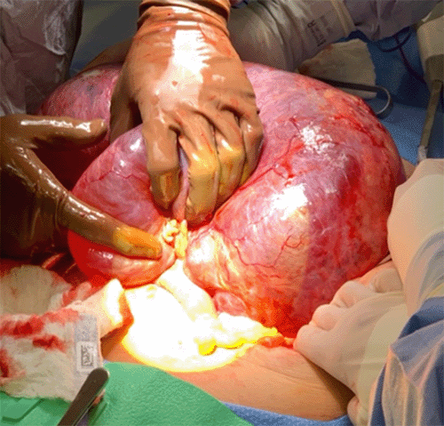 Large, cystic lesion with calcified components adherent to the small bowel muscularis propria