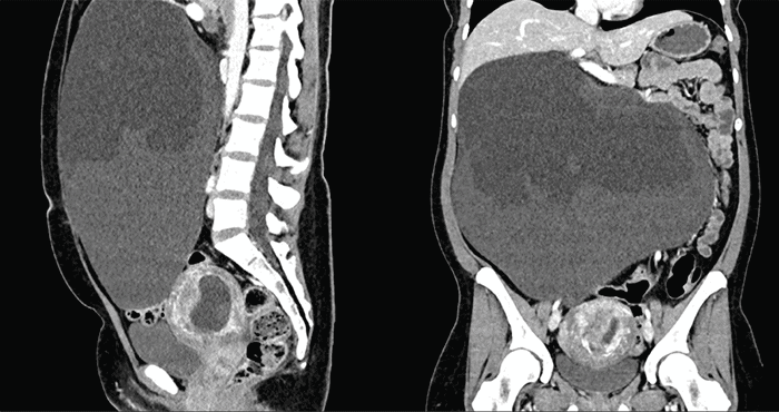 Well-defined, 16 x 20 x 30 cm cystic mass with fluid levels and no evidence of internal calcifications or fat density. The mass appears separate from adjacent organs and does not show signs of invasion