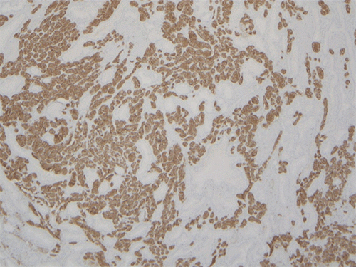 Synaptophysin immunohistochemical staining