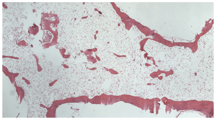 Section shows mature lamellar bone with marrow fat, an occasional hematopoietic element, and few bland spindle cells. No significant cytological atypia, atypical mitosis, or necrosis was identified