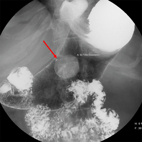 Tumor is nonobstructive, as evidenced by distal progression of oral contrast