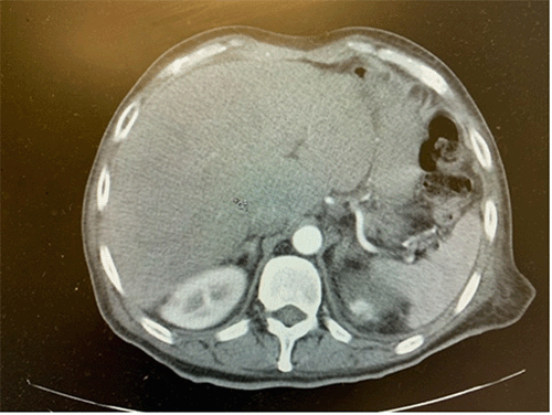 Axial contrast-enhanced CT scan of the abdomen obtained after completion of antimicrobial therapy and outpatient drain management. Note significant interval improvement with resolution of the previously identified left hepatic lobe abscess