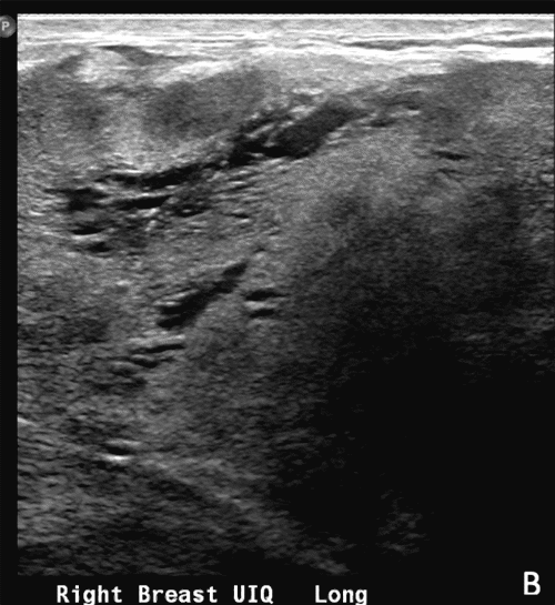 B) Right Upper Inferior Quadrant View of Breast on Long Axis