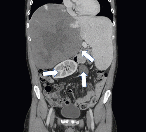 Hemangioma: Characteristic “centripetal fill-in” pattern is evident in the portal venous phase (arrow). Mass effect: Note the inferior displacement of the right kidney and leftward displacement of the gallbladder and inferior vena cava.