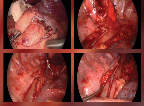 Video: Mediastinal Envelope Closure in Total Minimally Invasive Ivor Lewis Esophagectomy
