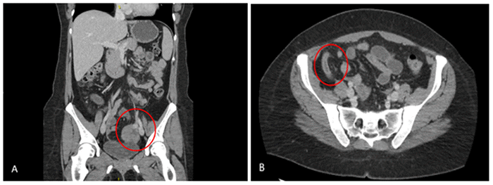 (A) Heterogeneous enhancing mass in the left adnexal region. No separate left ovary is identified. (B) Dilated appendix with increased mucosal enhancement and surrounding fat stranding (suggestive of acute appendicitis)