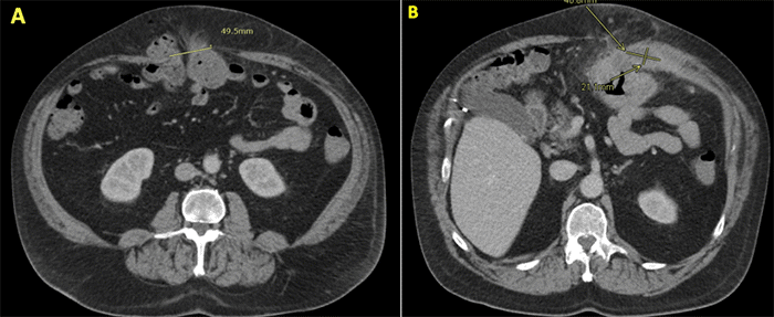 (A) Axial view depicting the large ventral hernia (hernia defect measuring approximately 49.5 mm in this image) containing a significant colonic mass (arrow) with evidence of invasion through the fascial defect into the abdominal wall. (B) Axial view demonstrating an associated complex fluid collection within the abdominal wall soft tissues (arrow), measuring approximately 40.8 × 21.1 mm, consistent with an abscess and surrounding inflammatory fat stranding.