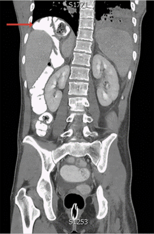 A (sagittal), Hepatic flexure interposed posteriorly and medially to the right liver lobe; and B (coronal), hepatic flexure interposed posterior and medial to the right liver lobe, consistent with Chilaiditi syndrome 