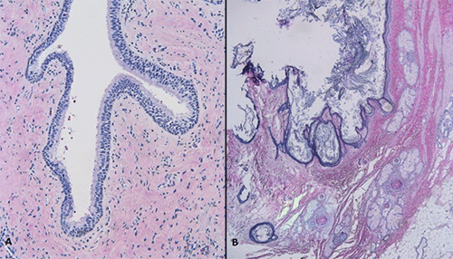 A, Respiratory epithelium and dense fibroconnective tissue; B, skin with adnexal structures, including hair follicles, keratin debris, pilosebaceous units, smooth muscle, and adipose tissue