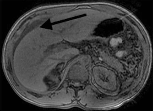 Delayed Presentation of Isolated Traumatic Gallbladder Rupture with ...