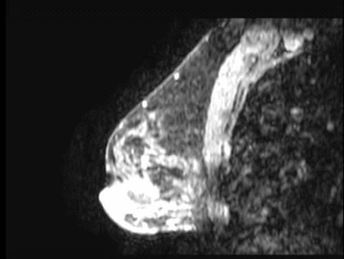 B) sagittal cut of right breast