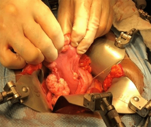 Multiple, yellowish lesions consistent with gastric xanthoma are evident on the gastric mucosa