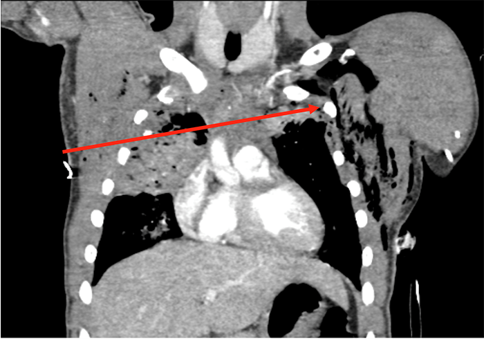 Figure 2. Coronal CT image of patient with Transmediastinal gunshot wound. Solid red line depicts bullet trajectory based on tissue injury on CT scan.