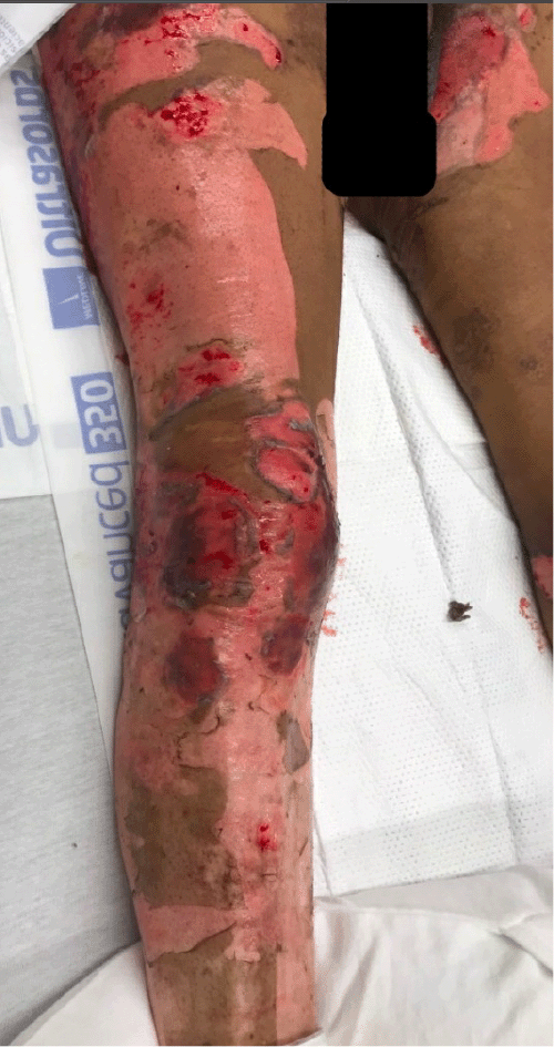 Clinical photograph displaying an open partial-thickness wound on the right lower extremity and erosions on the left inner thigh following debridement of flaccid bullae, typical of pemphigus vulgaris. (Penoscrotal lesions also present but not depicted)
