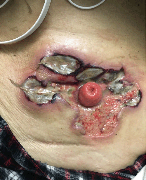 Photo taken prior to development of abdominal wall necrotizing soft tissue infection.