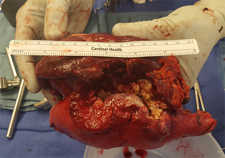 Figure 3. Resected gastric greater curvature and spleen