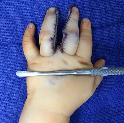 Figure 5. Immediate postoperative picture dorsal hand