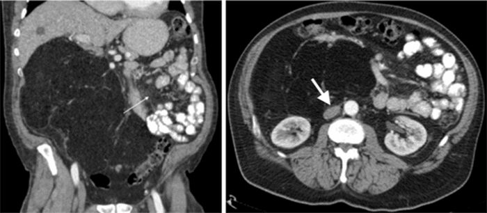 Small arrow: Denotes the mass significantly impacting adjacent bowel loops. Large arrow: Denotes the mass causing substantial compression of the inferior vena cava