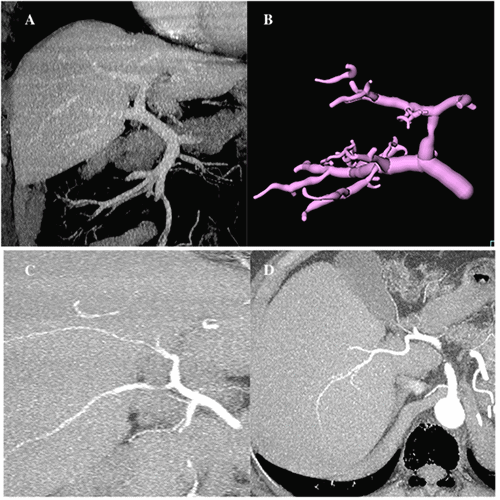 A and B) Donor portal vein anatomy consistent with a Nakamura type D configuration. C and D) Anterior sector supplied by a branch of the left hepatic artery coursing within the same portal pedicle as the right anterior sector portal vein