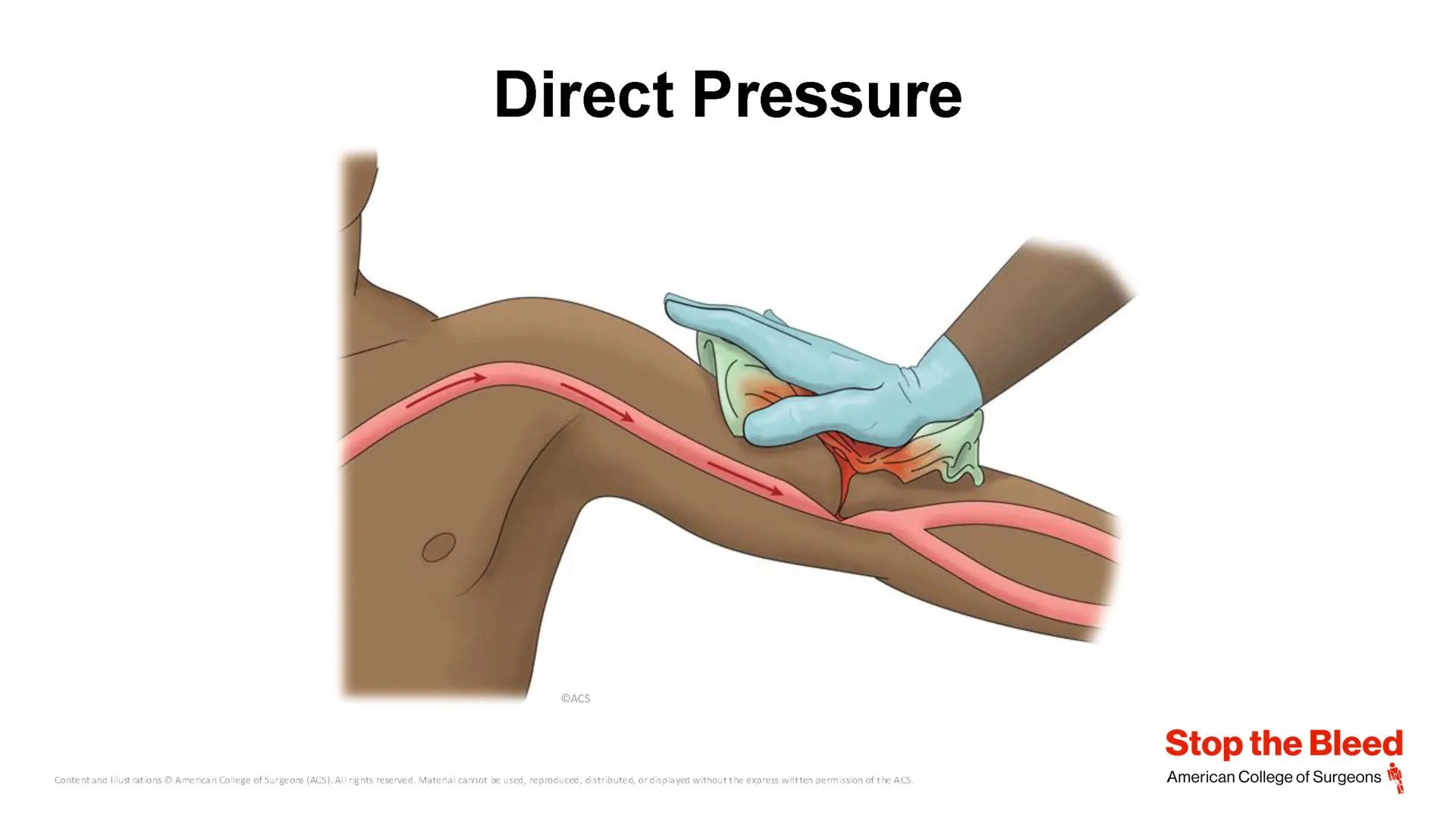 ACS Launches New Stop the Bleed Course, Updated Instructor Portal