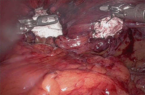 Intraoperative photograph showing the prosthetic repair of the bilateral Morgagni hernia defects using a tailored Gore-Tex (polytetrafluoroethylene) mesh